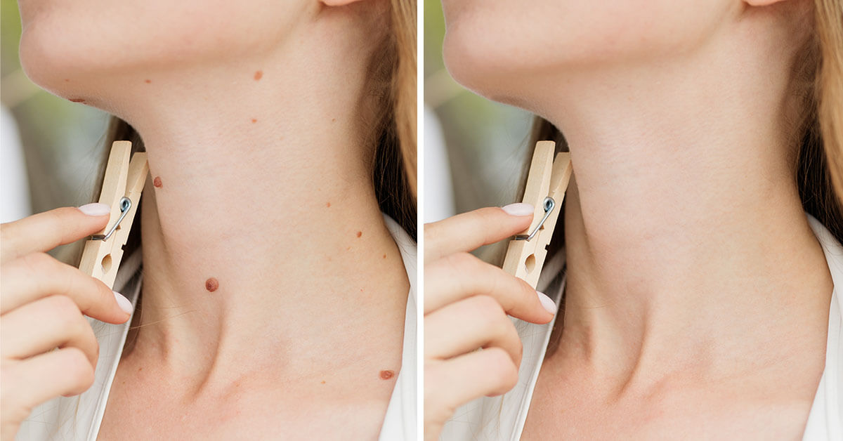 Remove a mole from photo with 1 click Pincel