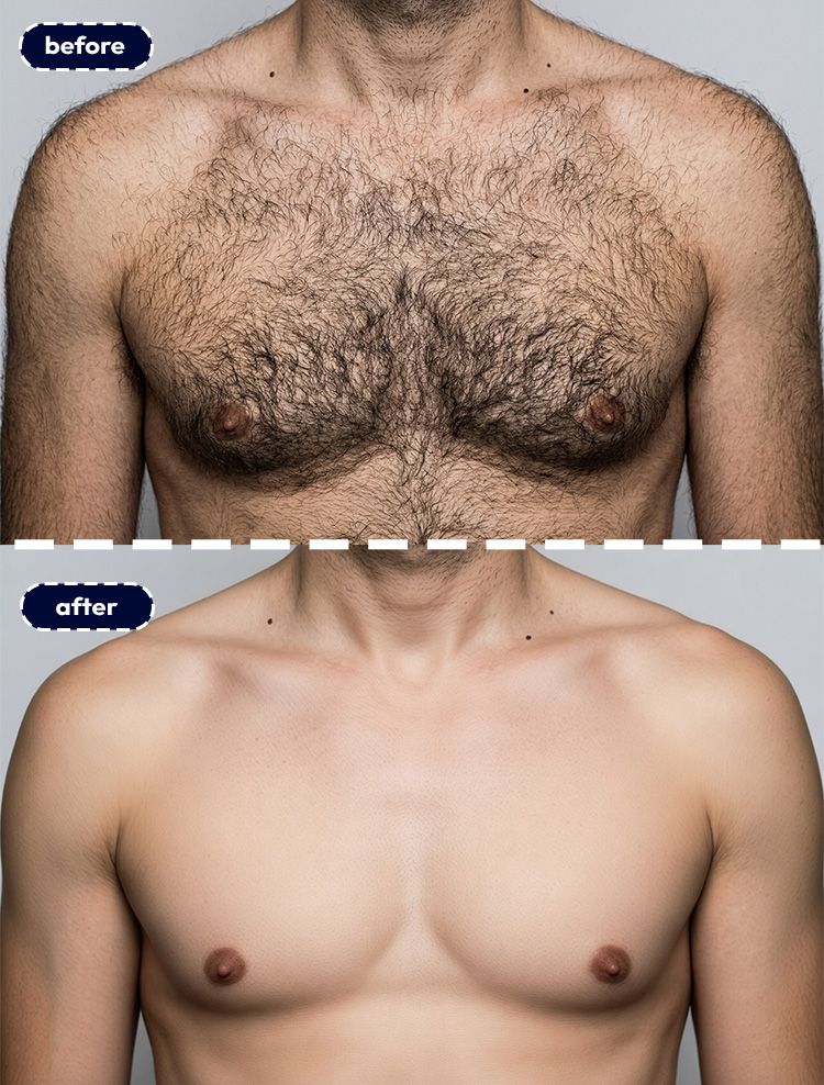 03_before-after-removing-chest-hair-with-pincel-AI-man-body