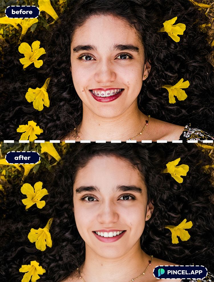03_before-after-removing-dental-braces-with-pincel-AI-young-woman
