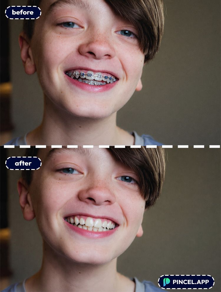 04_before-after-removing-dental-braces-with-pincel-AI-kids-selfie
